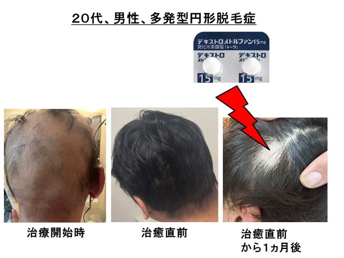 円形脱毛症　病院
